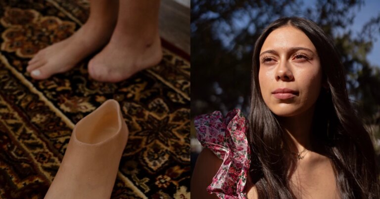 A college student fights an insurance denial to get a prosthetic foot before graduation